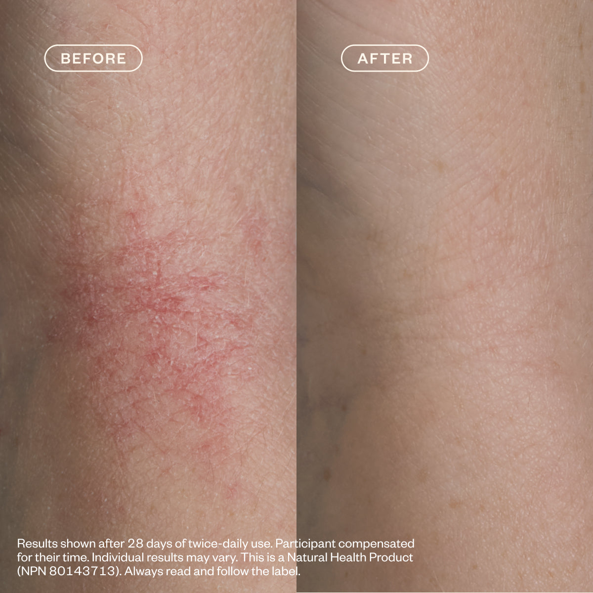 Dermedial™ Eczema+