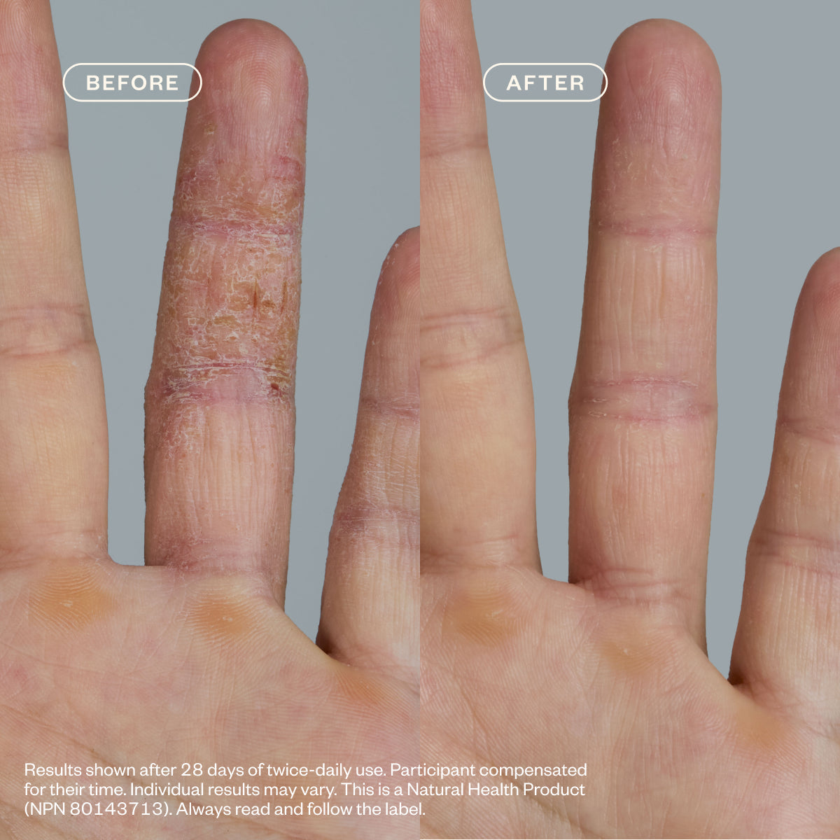 Dermedial™ Eczema+